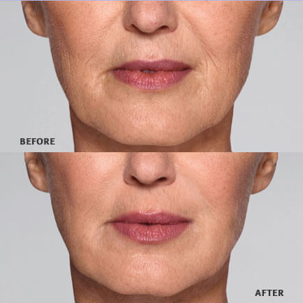 Restylane Refyne Facial Filler - Orange County, CA