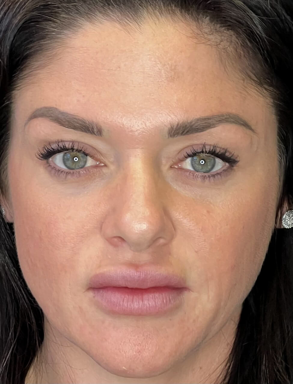 Juvederm Volbella XC injections Orange County, CA